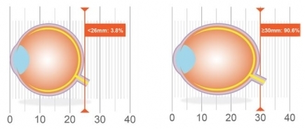 Association of axial length with risk of uncorrectable visual impairment