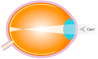 Myopic eye Myopic Eye