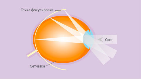 Traditional myopia correction Traditional myopia correction