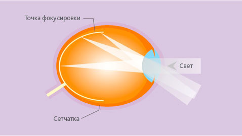 Optical treatment of myopia