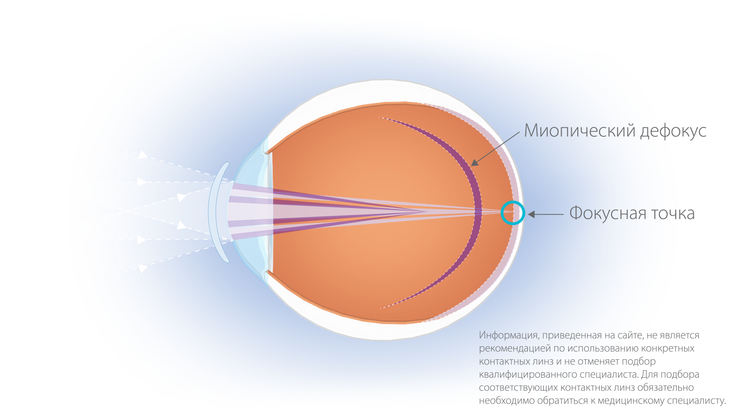 Какими линзами корректируется близорукость. Линзы Cooper Vision MISIGHT. Lens технология. Линзы MISIGHT 1 Day. Линзы для замедления прогрессирования миопии у детей.