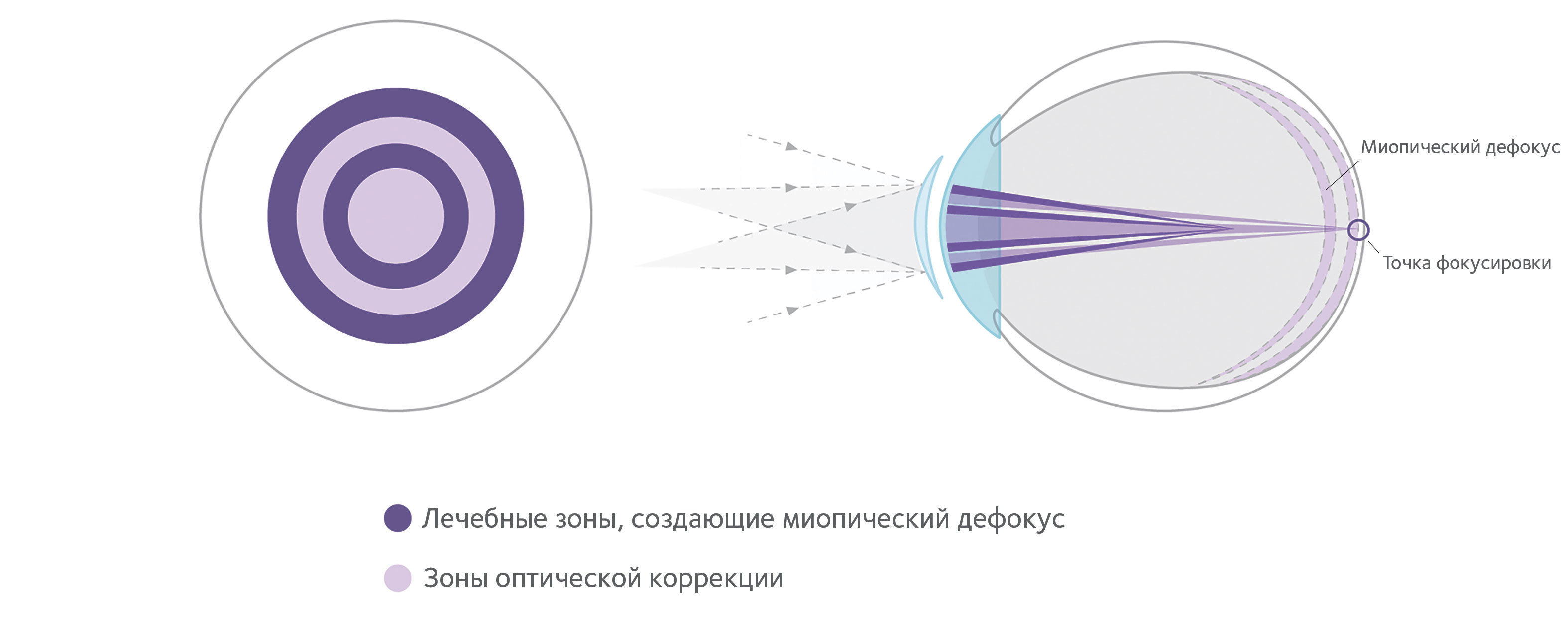 How MiSight 1 day contact lenses work